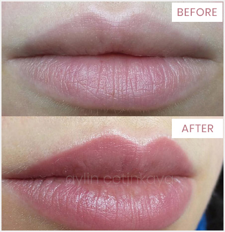 Permanent Lip Color Tattoo in Istanbul Turkey